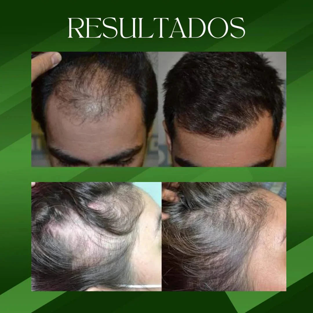 Ouhoe™ Elixir Capilar, recuperar el crecimiento natural, detener la caída (tamaño XL 100ml)