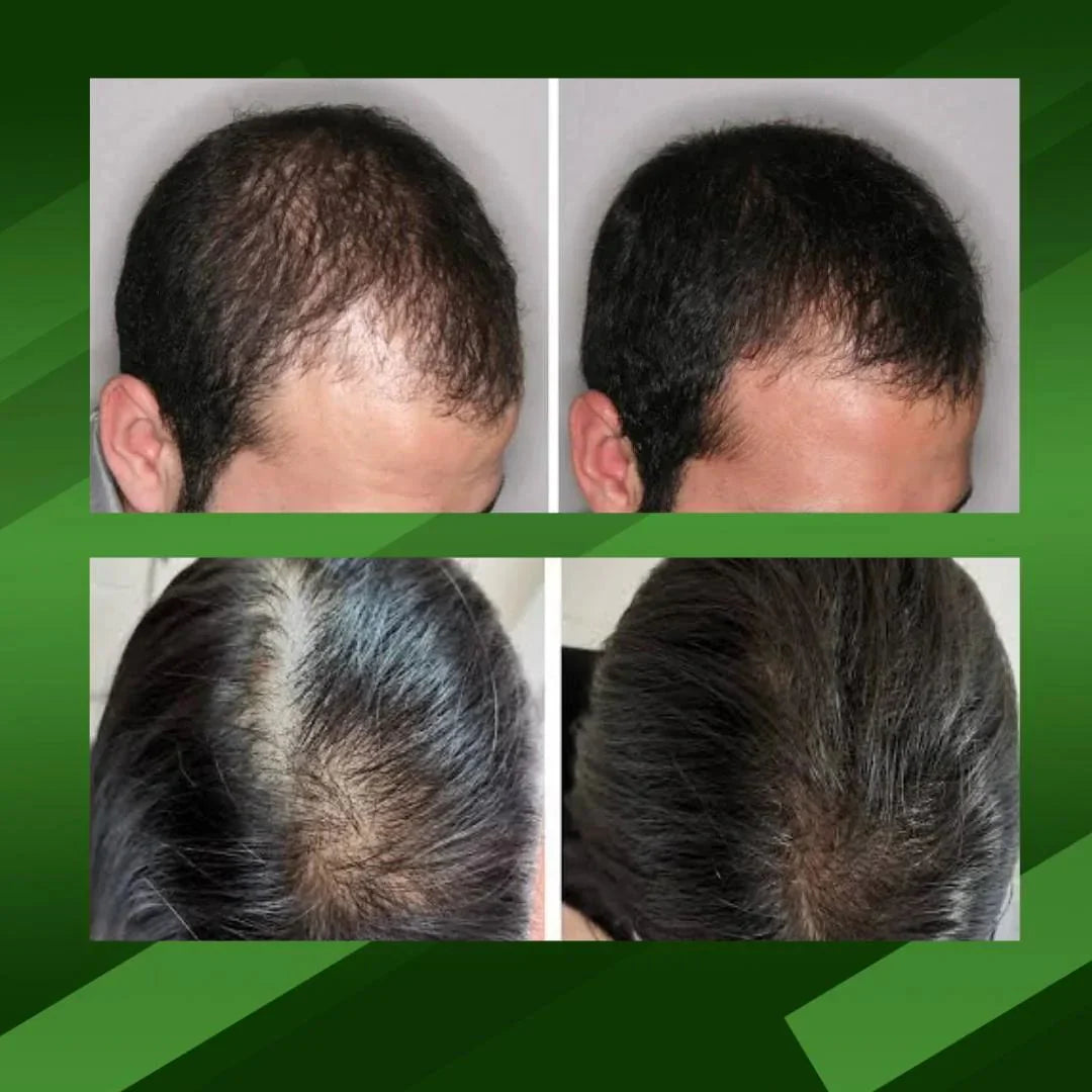 Ouhoe™ Elixir Capilar, recuperar el crecimiento natural, detener la caída (tamaño XL 100ml)