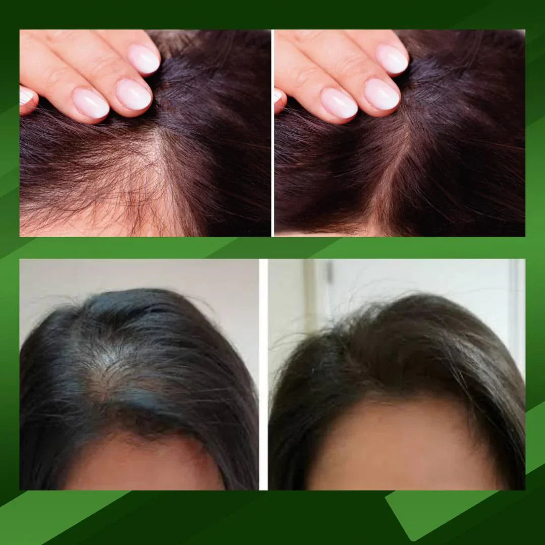 Ouhoe™ Elixir Capilar, recuperar el crecimiento natural, detener la caída (tamaño XL 100ml)